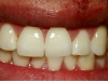 Lava Crowns 01 After
